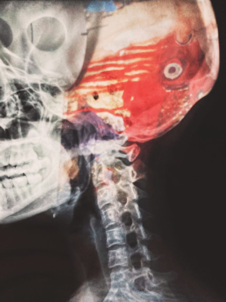 Brain injury lawyer - Smith Trial Group