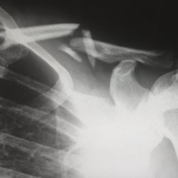 Car Accident Xray Shoulder