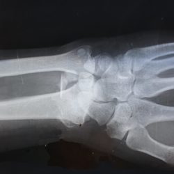 Xray Wrist broken bone