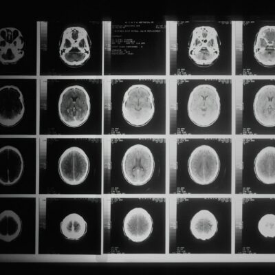 MRI brain scan images MRI brain scan images